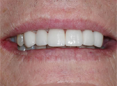 porcelain veneers smile one after