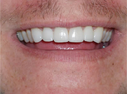 porcelain veneers smile three after
