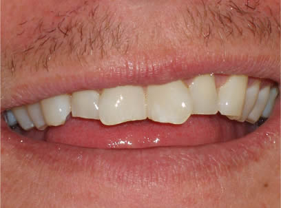 porcelain veneers smile three before