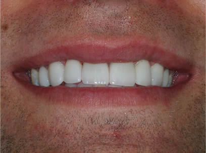porcelain veneers smile two after